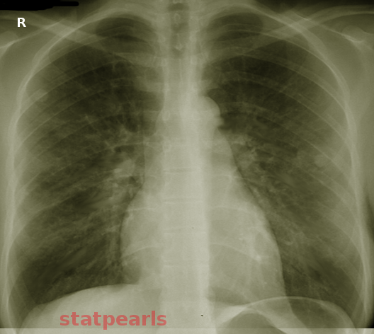 <p>Noncardiogenic Pulmonary&nbsp;Edema</p>