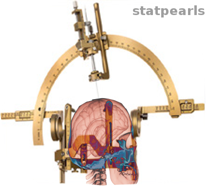 Stereotaxic surgery