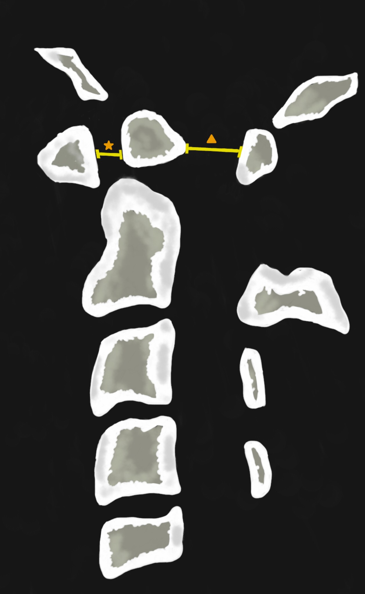 <p>Hypoplastic Odontoid Process