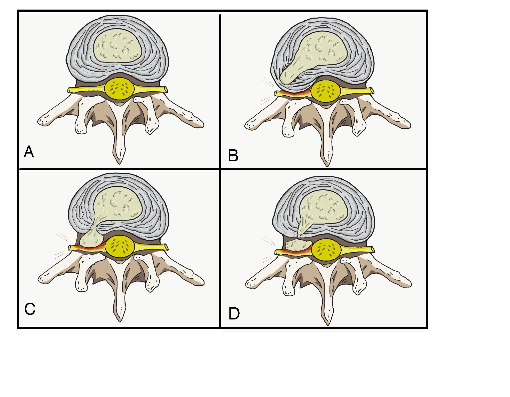 Figure 1 of Nucleus pulposus herniation