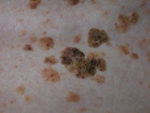 <p>Seborrheic Keratosis</p>