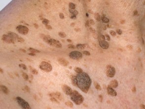 <p>Seborrheic Keratosis</p>