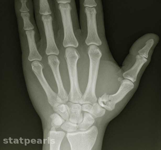 Rolando fracture