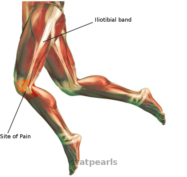 ITB friction syndrome