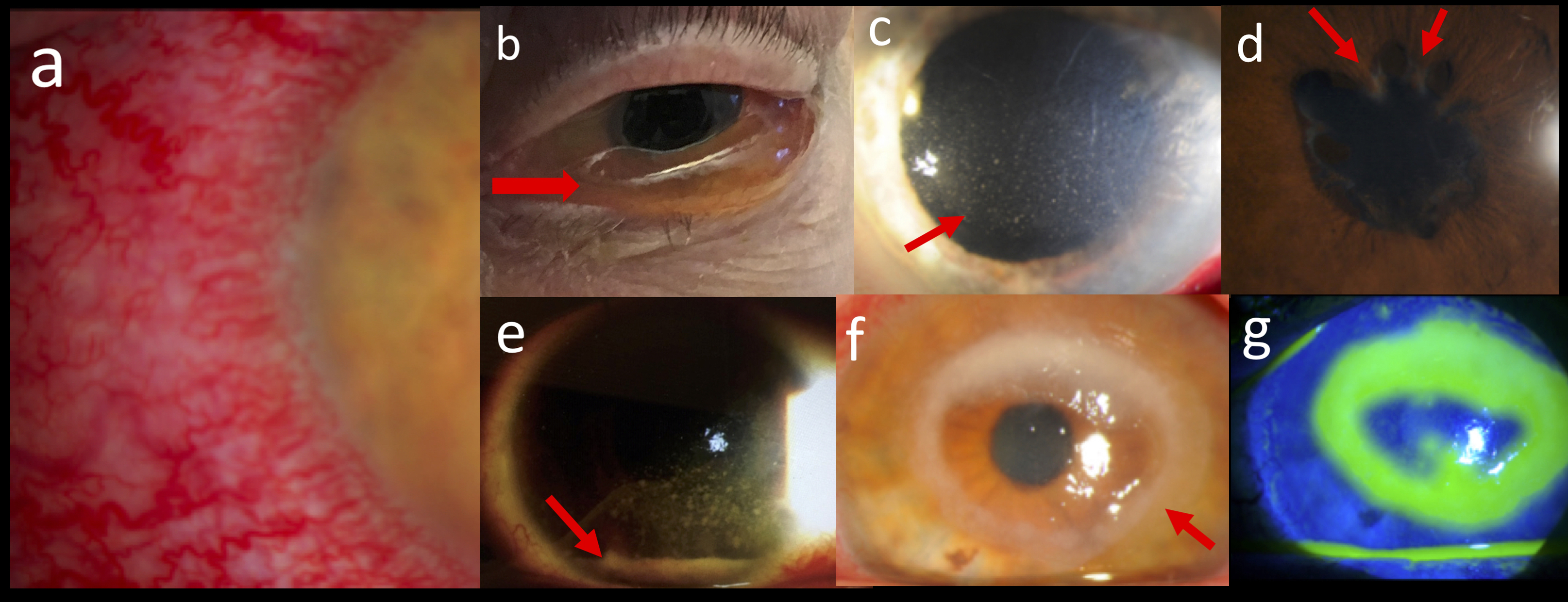 Important findings in differentiating a red, painful eye: (a) Ciliary flush, (b) chemosis (red arrow), (c) keratic precipitates (red arrow), (d) posterior synechiae (red arrows), (e) hypopyn (red arrow), (f) ring infiltrate (red arrow), and (g) fluorescein staining of ulcer found in (f).
