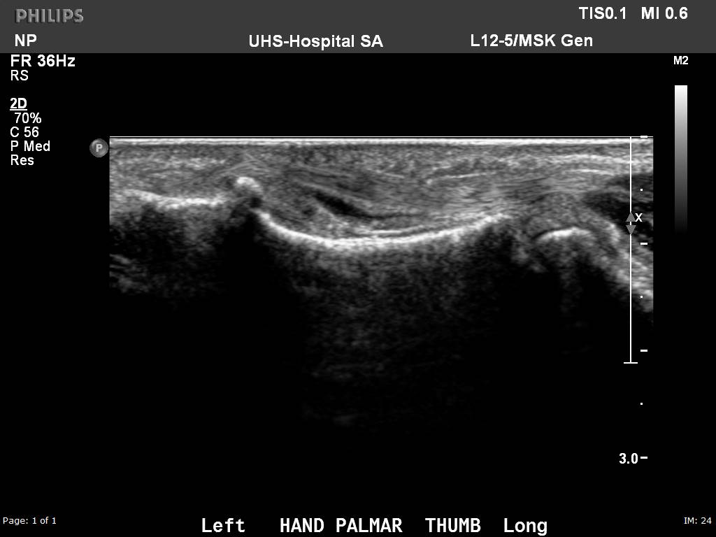 Ultrasound image of the thumb in a patient with a history of Rheumatoid Arthritis shows an abnormal amount of fluid within the flexor pollicus longus tendon sheath, consistent with an inflammatory tenosynovitis.