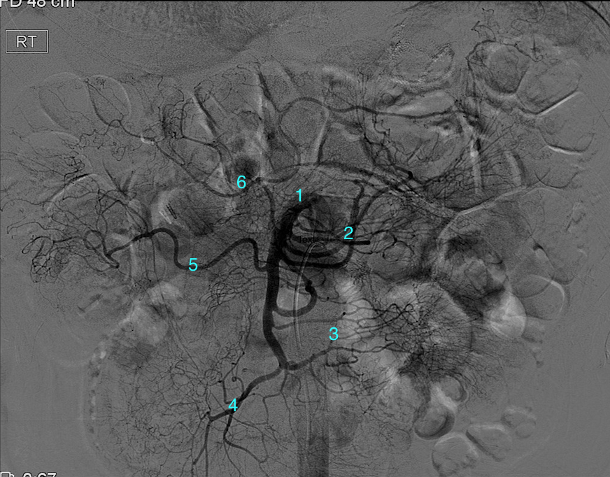 <p>Conventional Angiogram of the Superior Mesenteric Artery