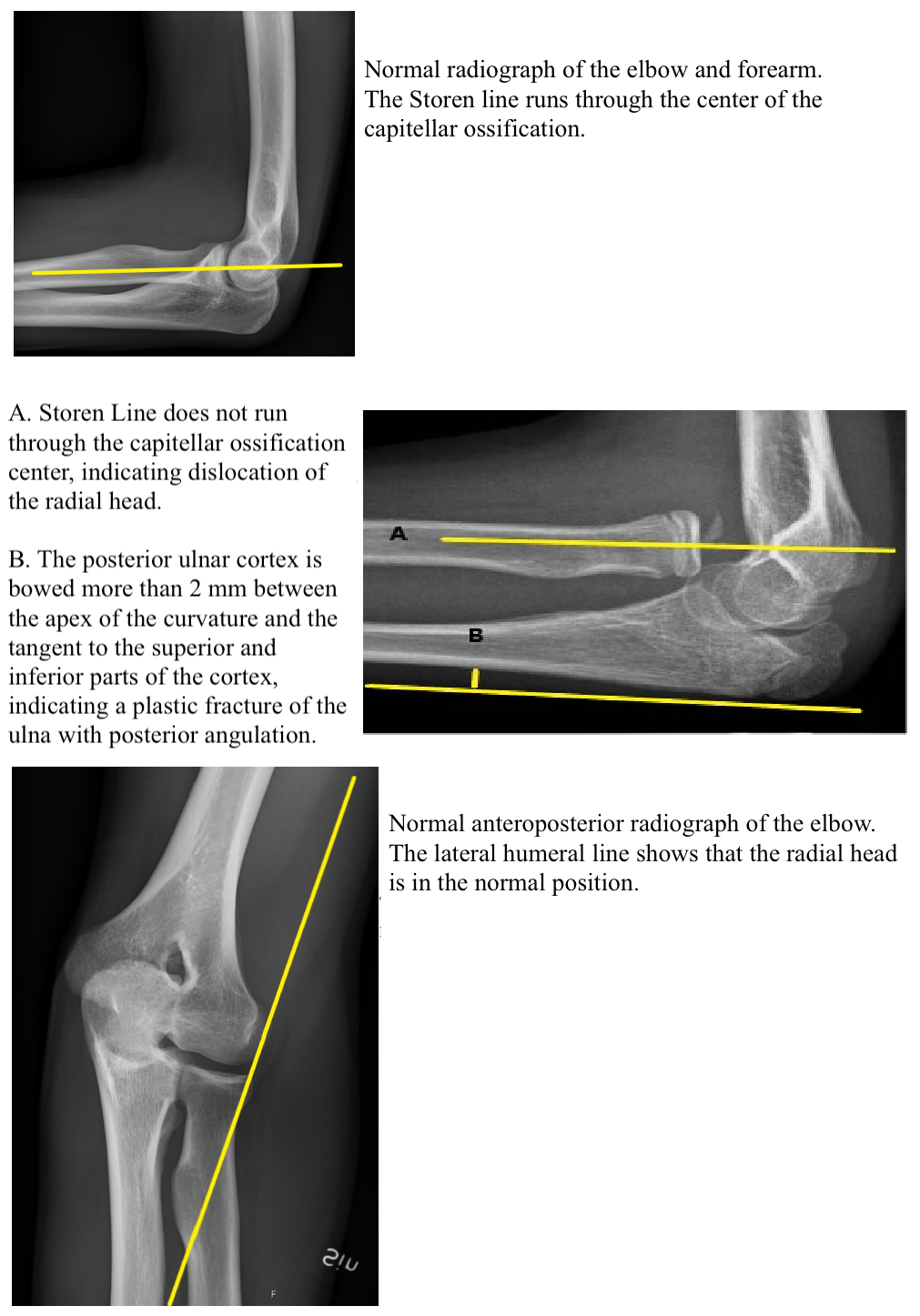 <p>Radial Head Dislocation