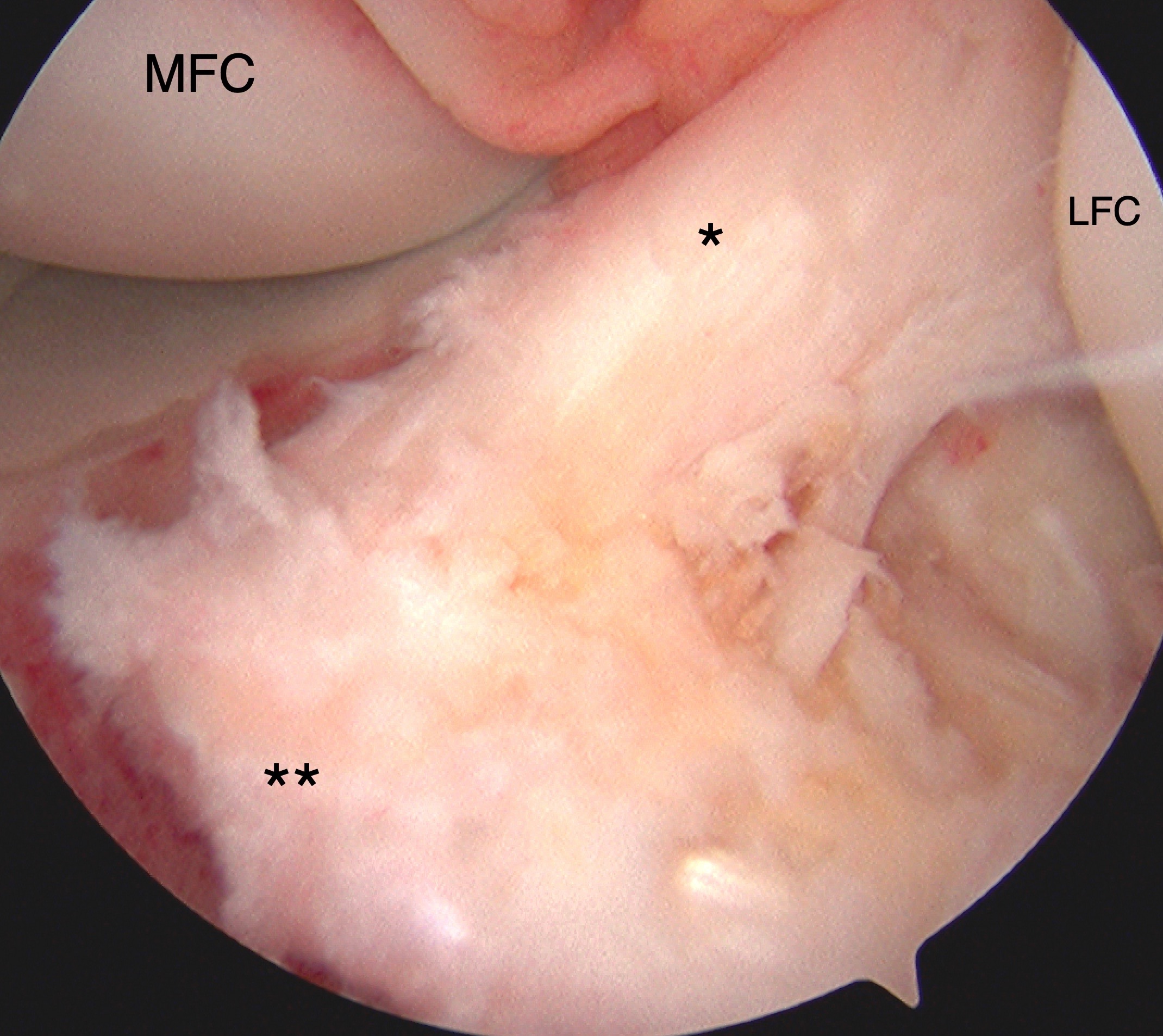 <p>Tibial Eminence Arthroscopic Reduction and Internal Fixation