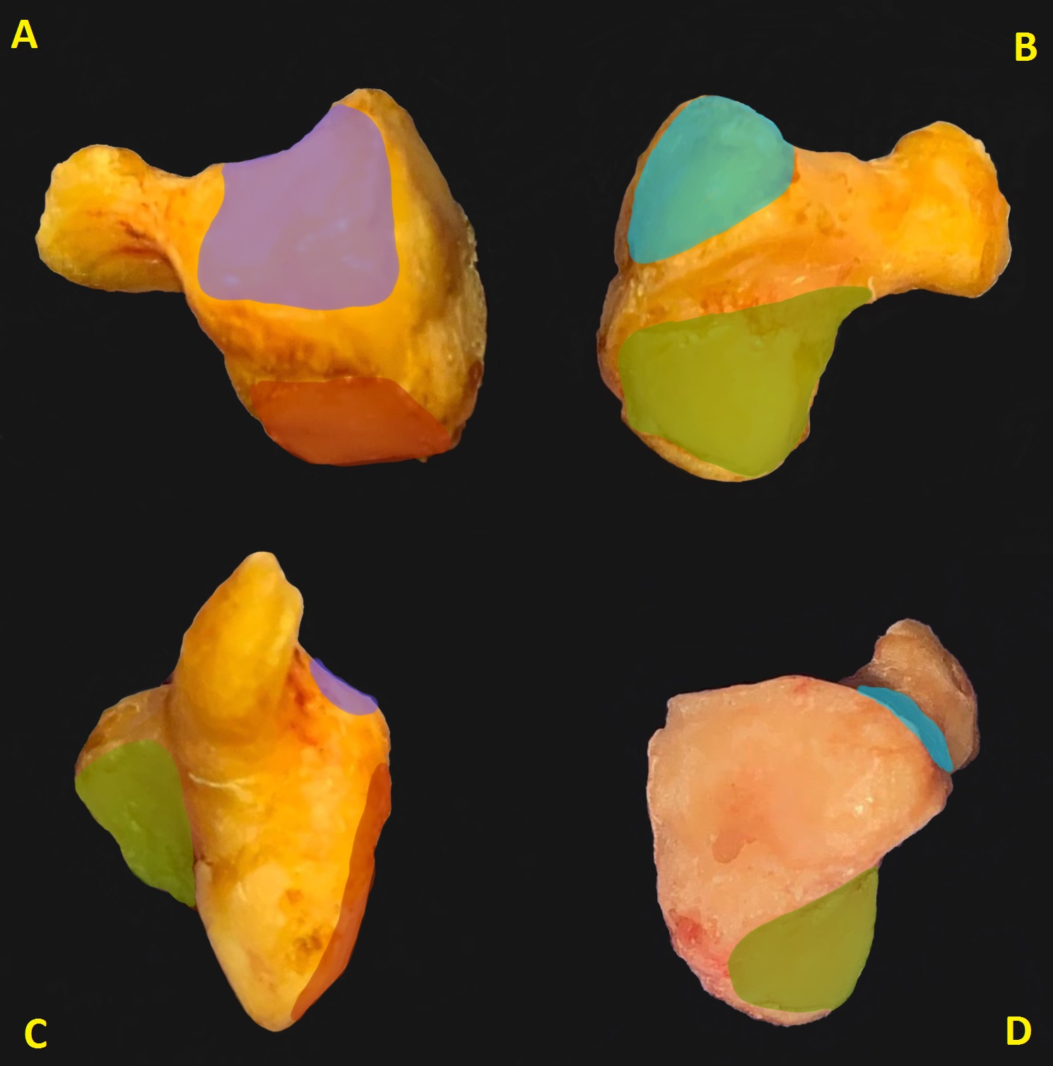 Figure 1. Fresh hamate bone dissection. Radial view (A) with articular surface for fourth metacarpal (violet) and capitate bone (red). Ulnar view (B) showing fifth metacarpal articular surface (light blue) and triquetrum (green). Volar view (C). Dorsal view (D).