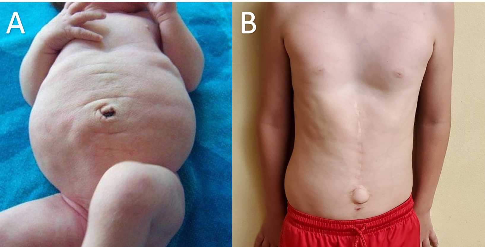Prune belly syndrome - A. At birth B. At nine years of age (surgical scars noted from a prior abdominoplasty procedure)