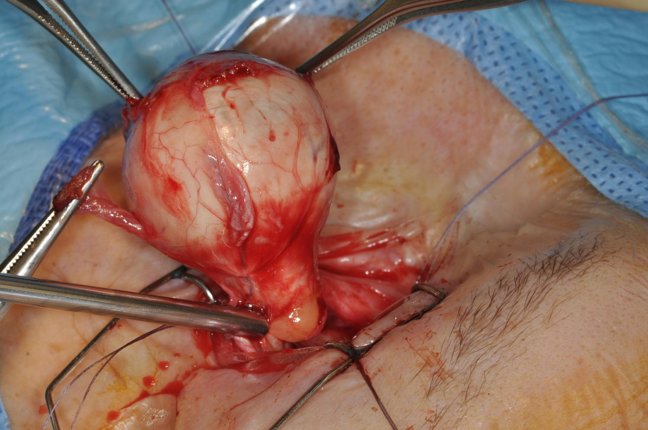 <p>Eye Enucleation and the Inferior Oblique