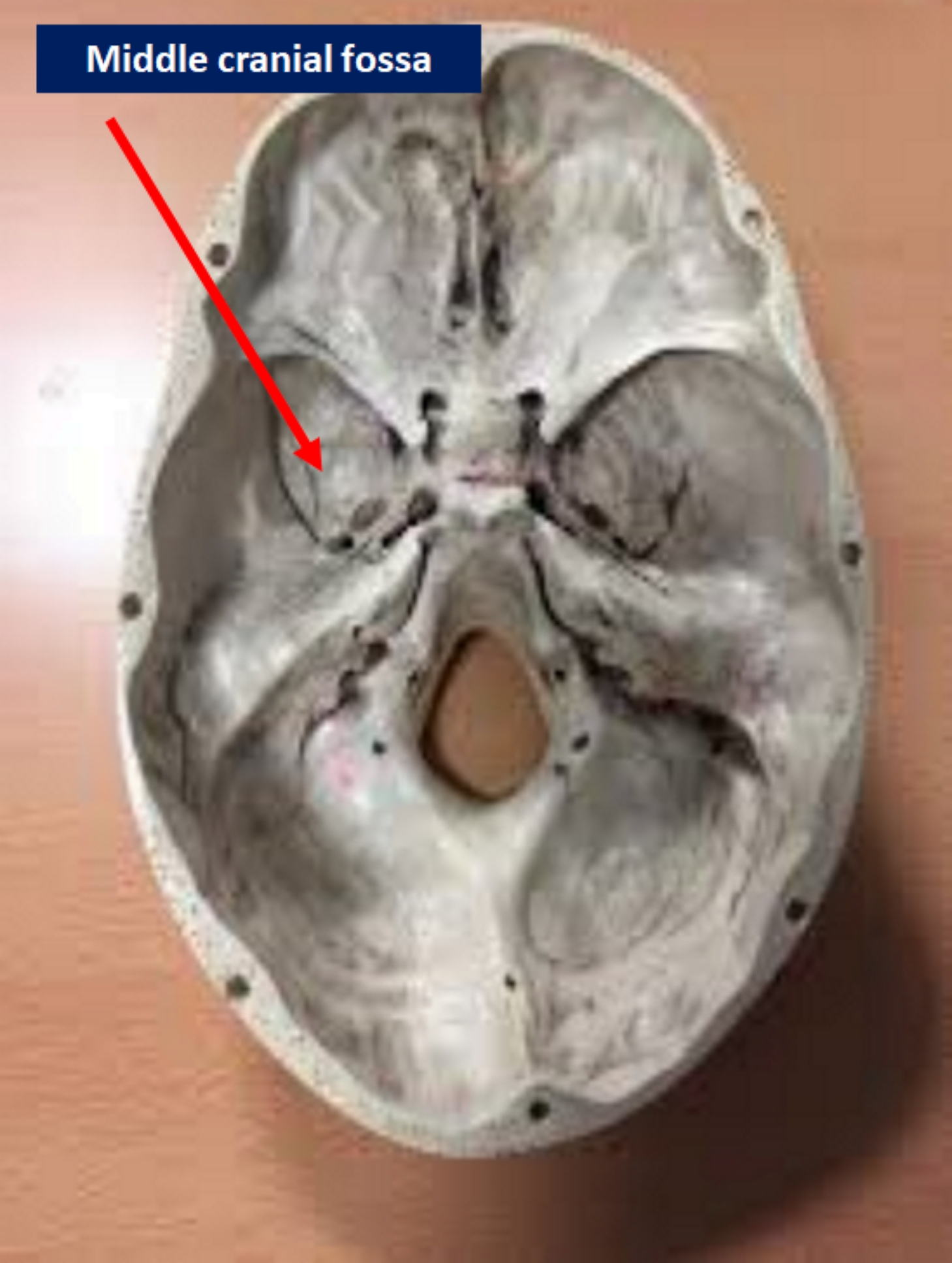 Middle cranial fossa