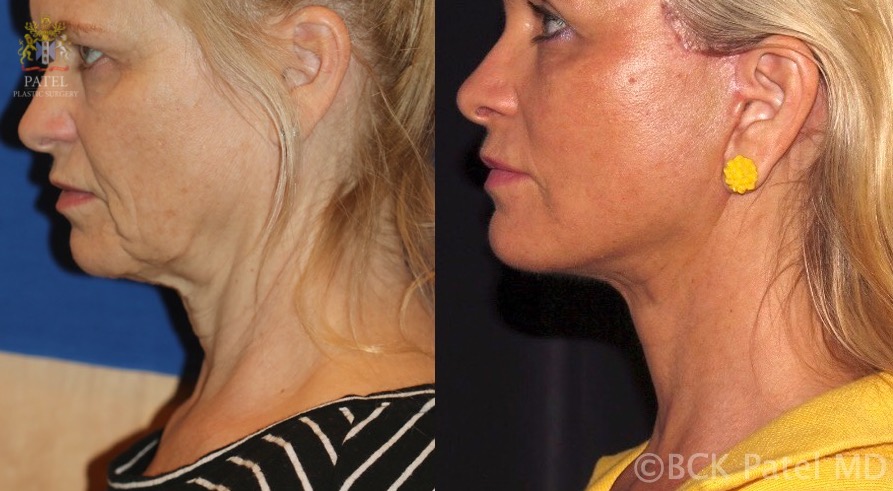 Result of a deep-plane facelift. Note the re-volumization of the midface with improvement in the projection of the malar eminence, improvement of the jowl with appropriate platysmal and SMAS repositioning and buccal fat pad reduction.