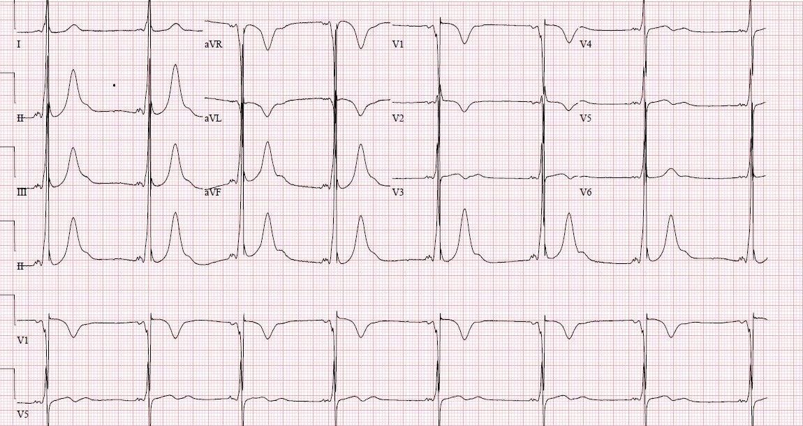 WPW Syndrome Type B