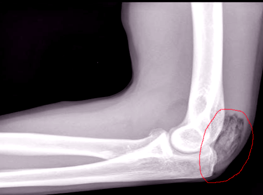 Heterotopic ossification