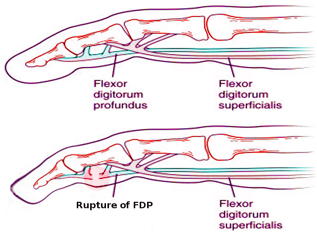 <p>Jersey Finger