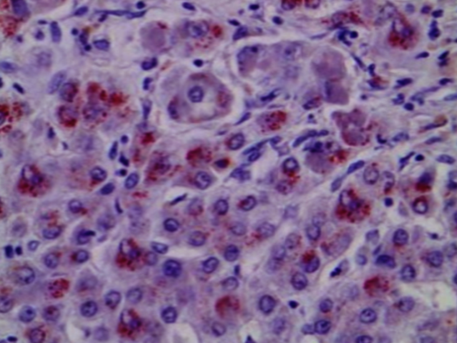 Wilson disease