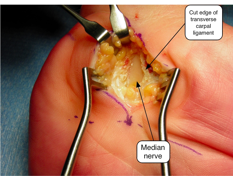 <p>Transverse Carpal Ligament Surgery