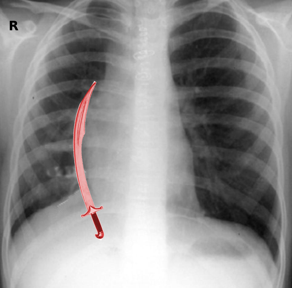 <p>Scimitar Syndrome on Chest Radiography