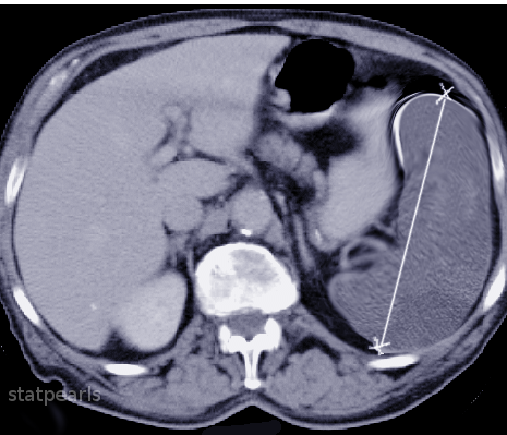 CT Splenomegaly