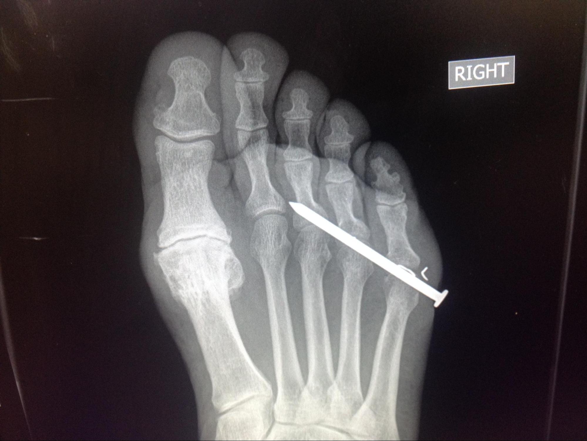 Foreign Body Imaging
Foot radiograph with metallic foreign body (nail).