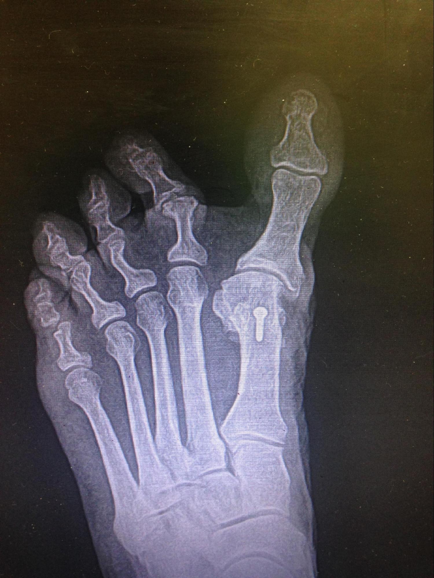 <p>Iatrogenic Hallux Varus