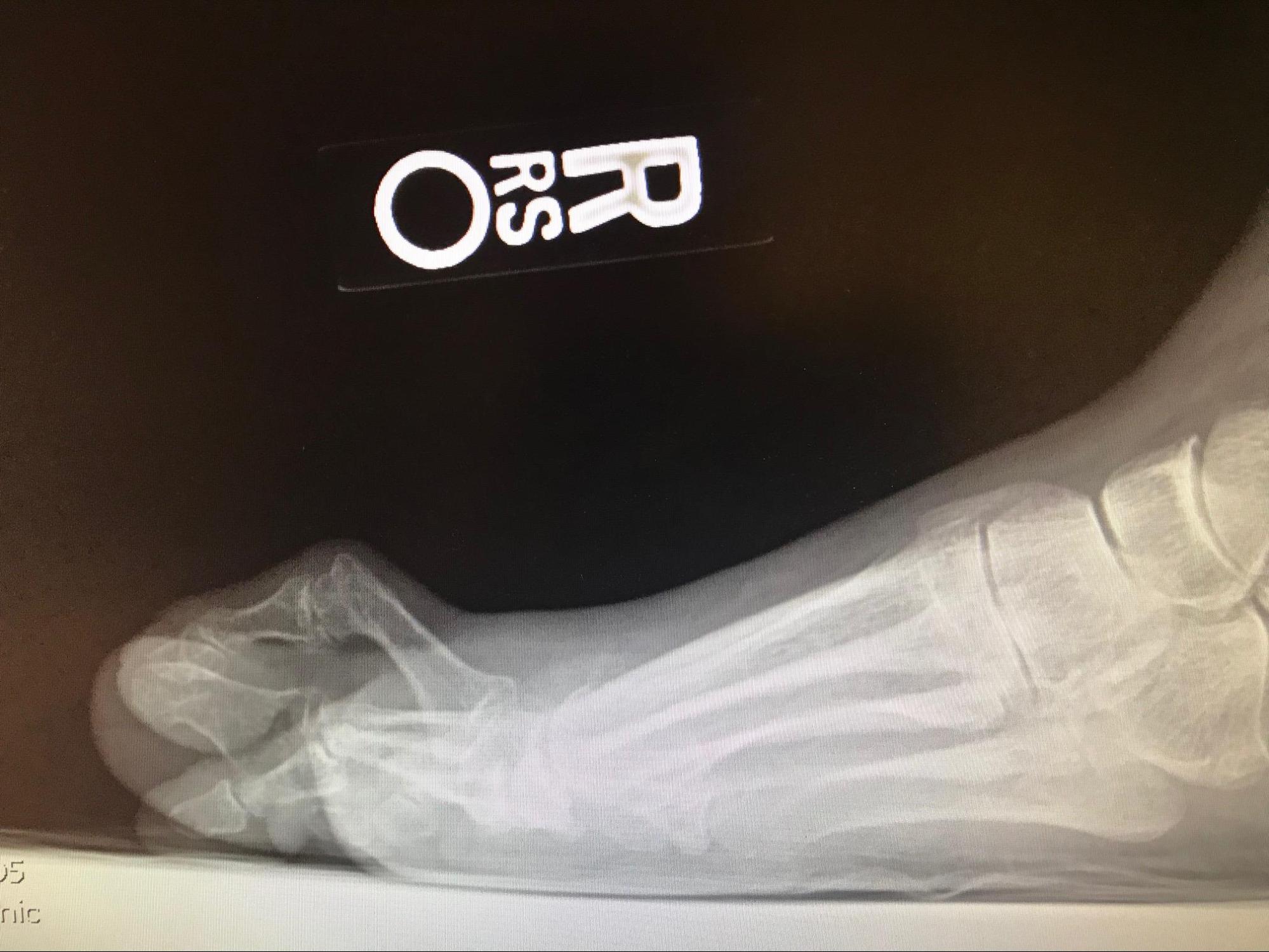 Hammertoe
Lateral weight-bearing radiograph demonstrating a hammertoe deformity with extension at the MPJ and contracture at