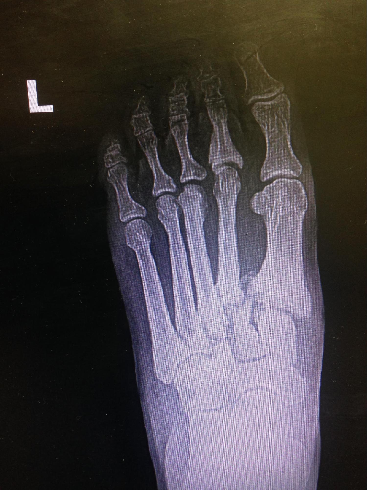 <p>Lisfranc Dislocation