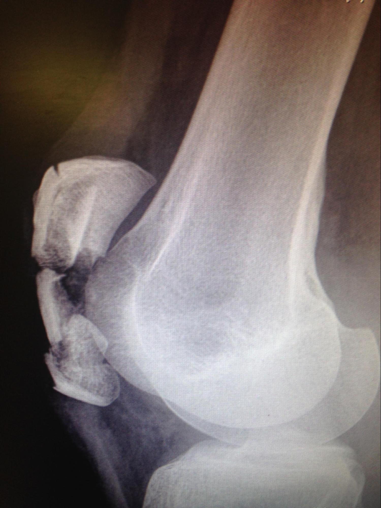 Patellar Fractures
Note the comminution and displacement. 