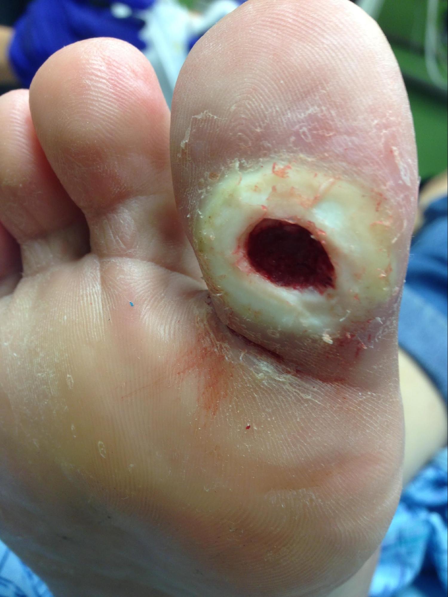 Diabetic Foot Ulcer
Neuropathic ulceration in a diabetic patient. 
Note periwound callous formation. Wagner Grade 2 