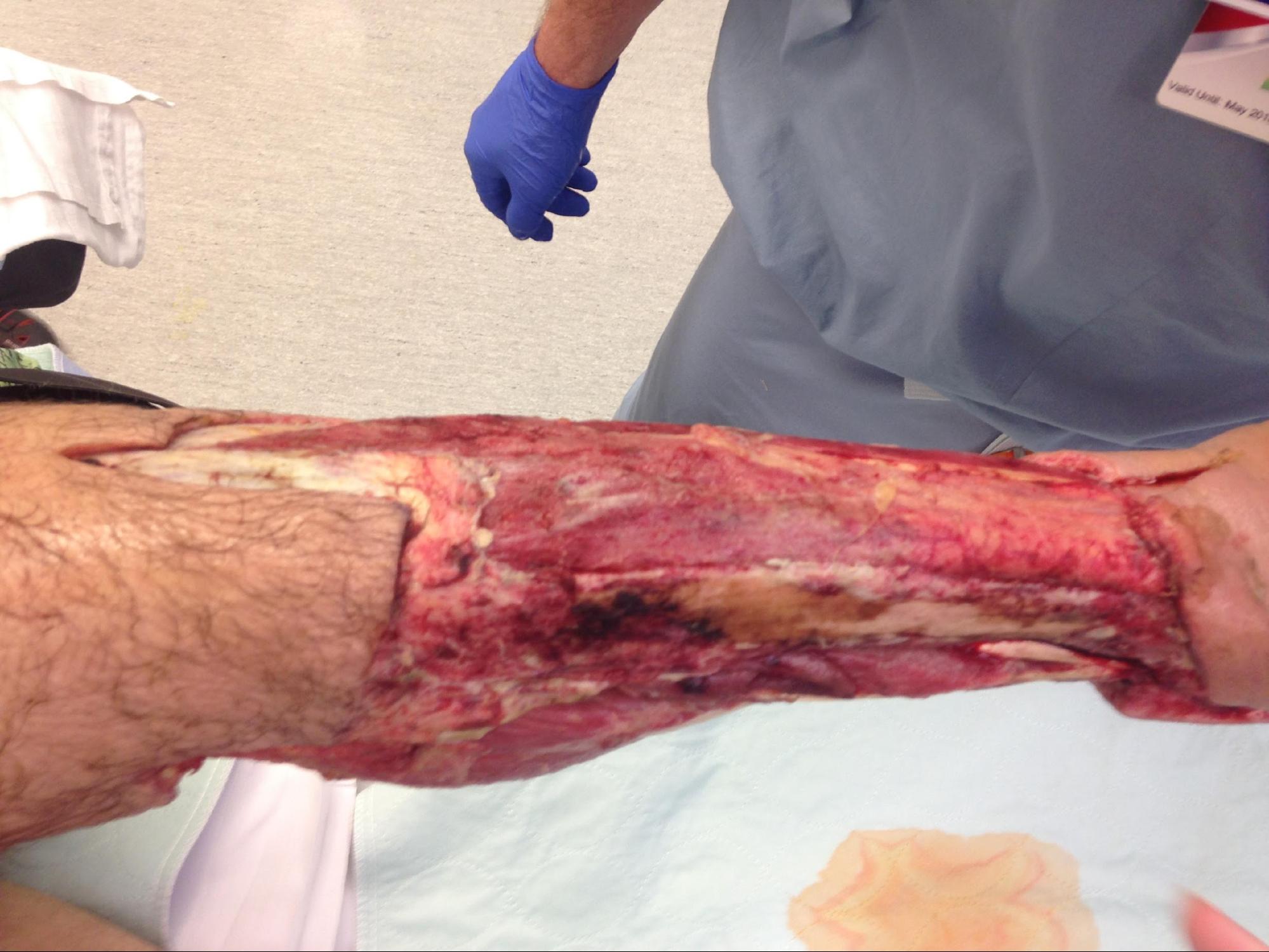 <p>Necrotizing Fasciitis. The appearance of the lower leg after serial debridements of skin and fascia.</p>