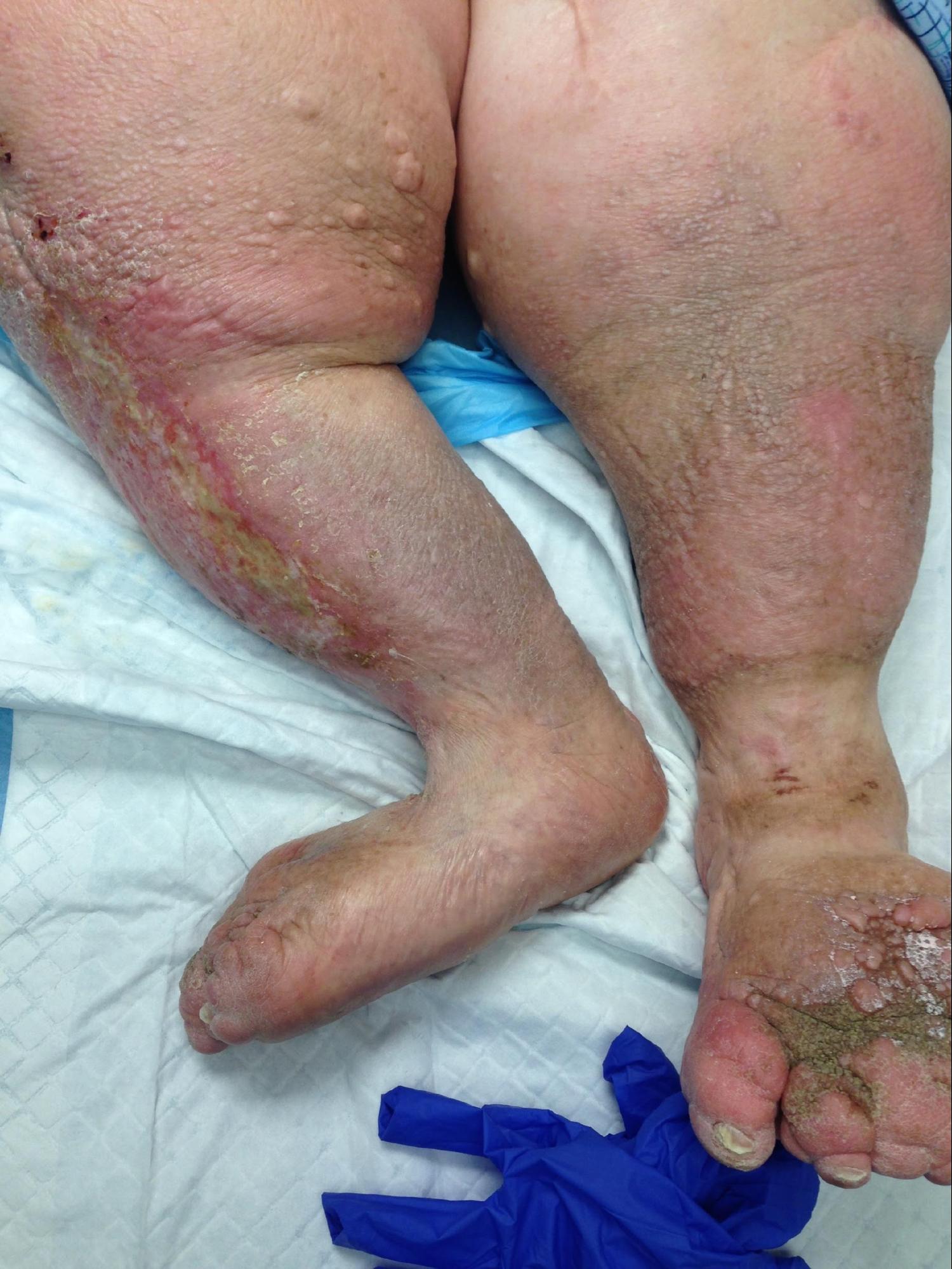 Lymphedema 
Stage 4 Lymphedema; note the skin changes, edema, fibrosis, and papillomas.