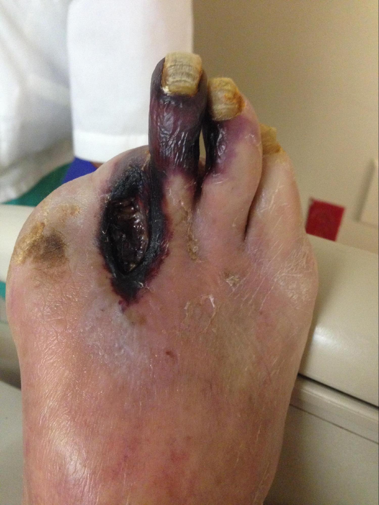 Peripheral Arterial Disease
Non-healing necrotic ulceration and gangrene of the 3rd digit secondary to PAD. 