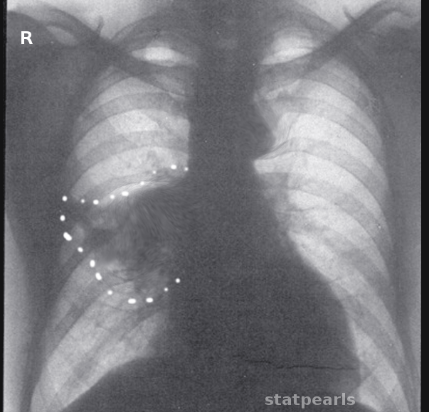 Middle lobe syndrome