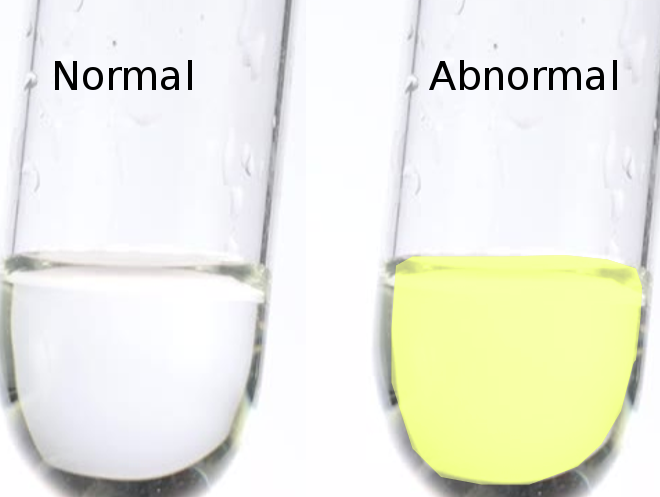 Lumbar puncture