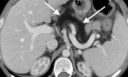 <p>Fatty Replacement of Pancreas Seen&nbsp;on Computed Tomography.</p>