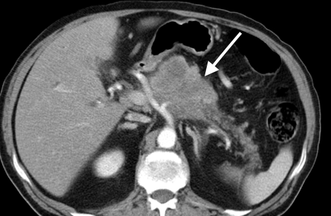 <p>Pancreatic Adenocarcinoma, Computed Tomography.</p>