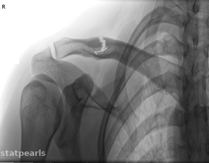 Clavicle fracture