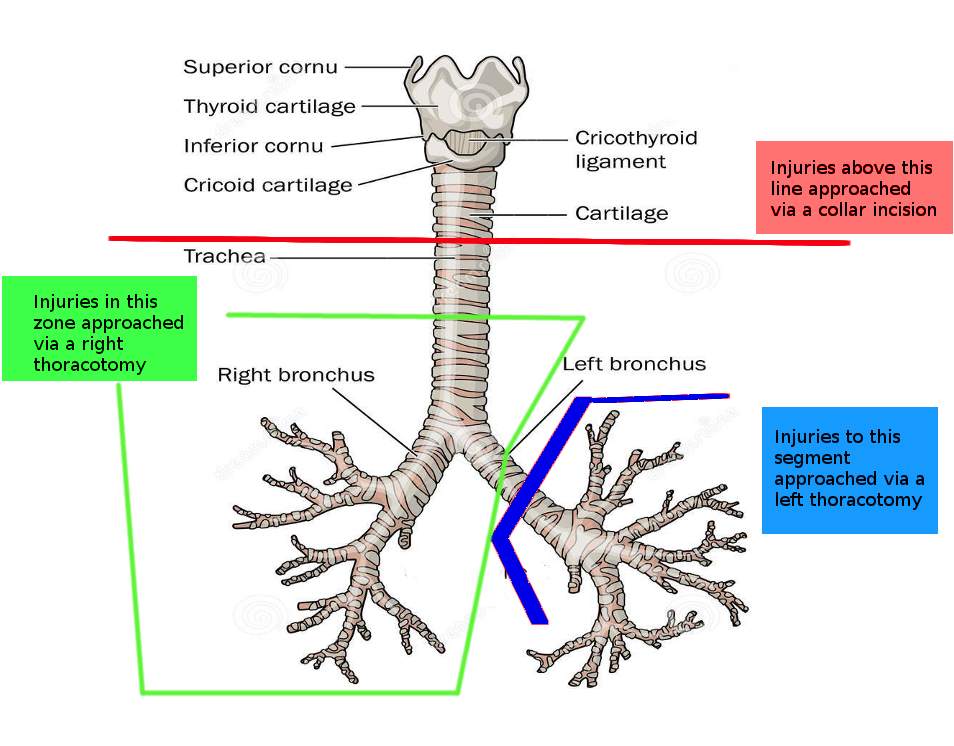 <p>Incisions for Tracheal Surgery</p>