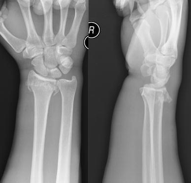 <p>Smith Fracture Radiography. Posteroanterior and lateral (PAL) view of a type I right Smith fracture.&nbsp;</p>