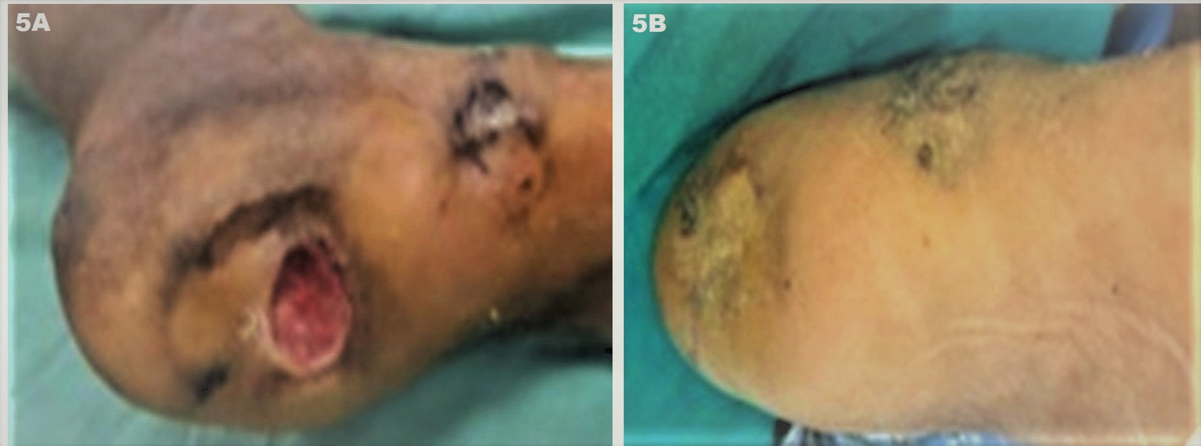 Figure 5. JODHPUR TECHNIQUE (JT) – Depiction of success of the technique in a non-healing foot ulcer of a diabetic patient with diabetic foot (diabetes controlled with HbA1C < 6.5 X one year). (A) Baseline multiple ulcers over the foot involving the heel and medial malleolus (pressure sites). The lesions are chronic non-healing ulcers (CNHUs) as they failed to heal despite multiple treatment sessions using collagen dressings, platelet-rich fibrin matrix (PRFM), hyberbaric oxygen as well as one flap transplant that necrosed within 4 weeks; and (B) Complete healing of ulcers can be appreciated after 3 months of two sessions of JT performed  one month apart.  