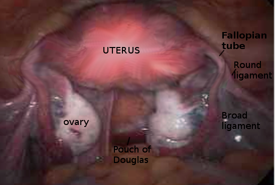 Pelvis laparoscopy