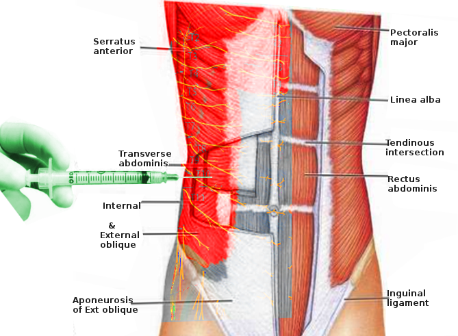 <p>Transverse Abdominis Plane Block</p>