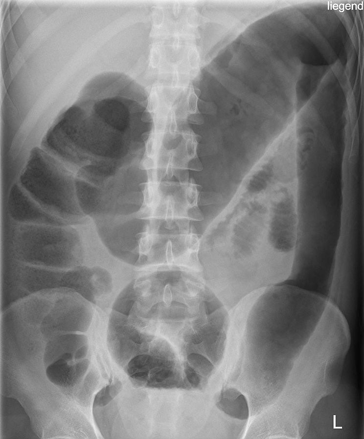 Toxic megacolon