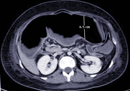 CT Toxic megacolon