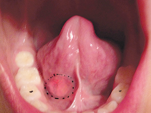 Submandibular mass