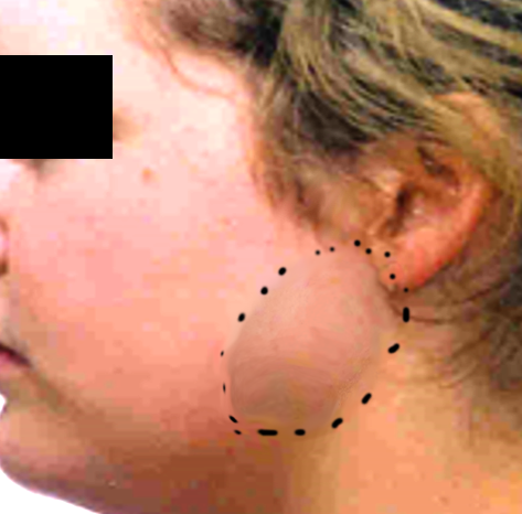 <p>Parotid Mass</p>