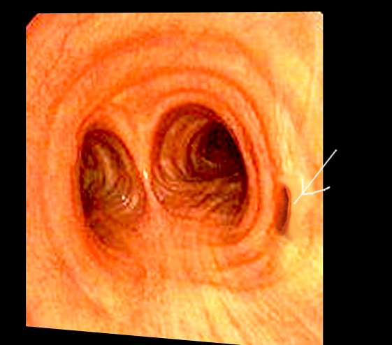 Tracheal bronchus-bronschoscopy