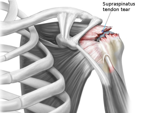 <p>Rotator Cuff Tear.</p>